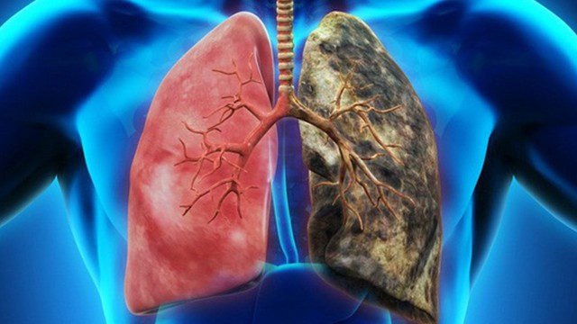 Bệnh ung thư phổi và những lầm tưởng phổ biến